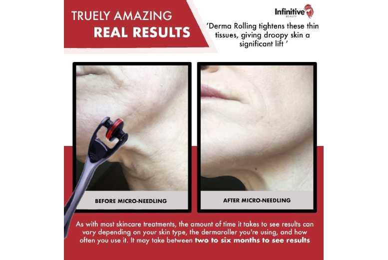 Mt Titanium Derma Roller 180 - Anti-Ageing Micro-Needling Tool For All Skin Types