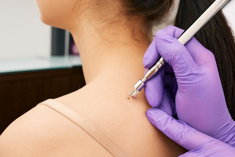 Pigmentation And Mole Removal For 1: Face And Body Areas - Dublin
